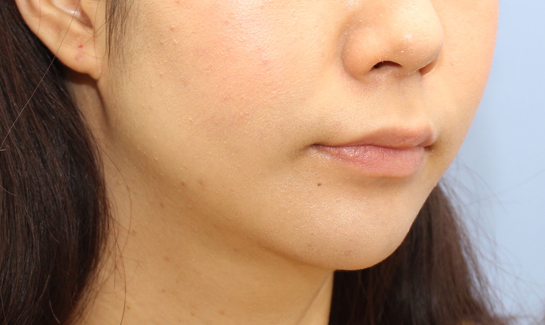 Microneedling after