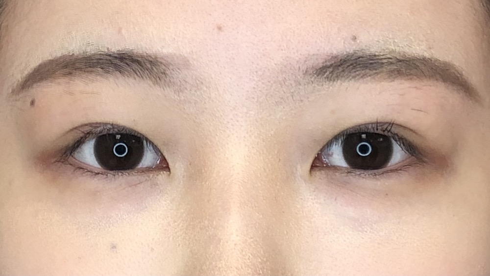 004 [Maibotsu / Double Eyelid Thread Technique] | Shonan Beauty Clinic