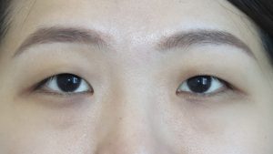 011 [Maibotsu / Double Eyelid Thread Technique]