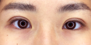 10 [Instant Double Eyelid Surgery]