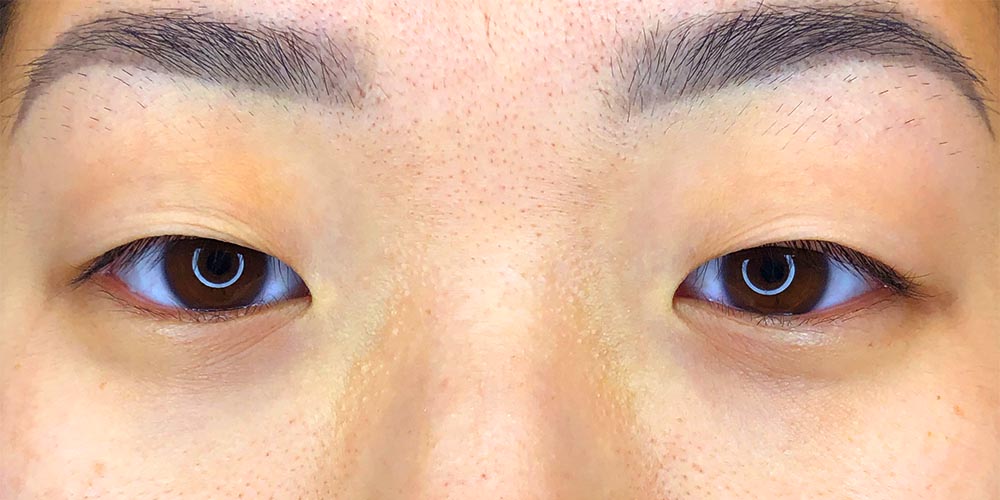 21 [Instant Double Eyelid Surgery]