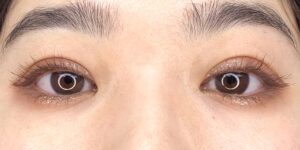 24 [Instant Double Eyelid Surgery]