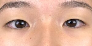 25 [Instant Double Eyelid Surgery]