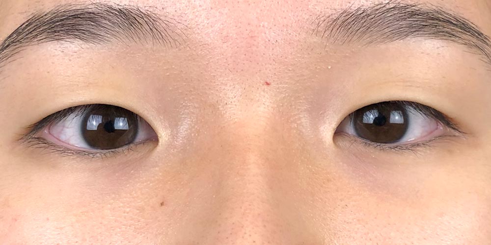 25 [Instant Double Eyelid Surgery]