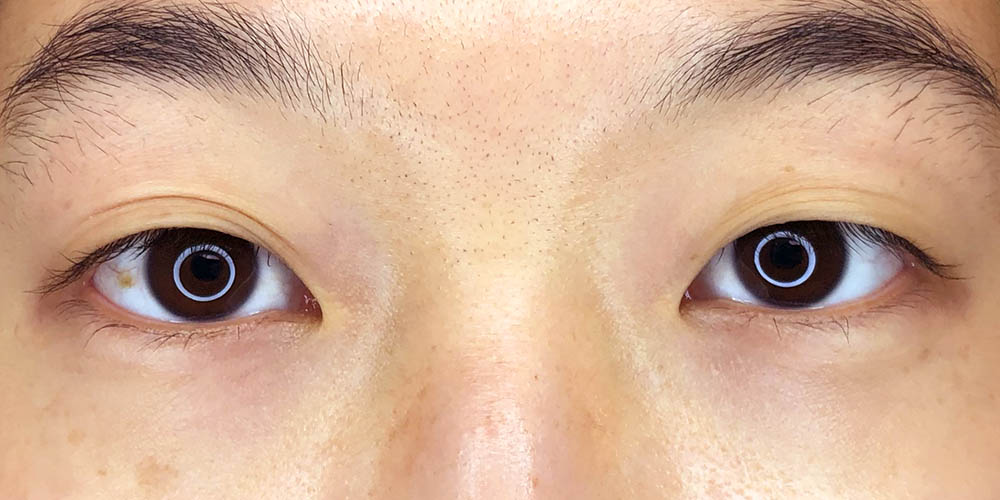 26 [Instant Double Eyelid Surgery]