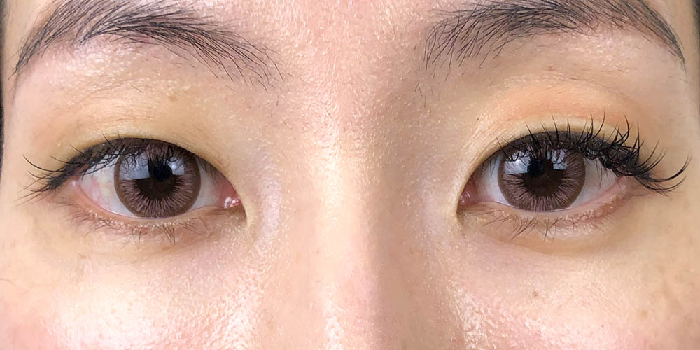 27 [Instant Double Eyelid Surgery]