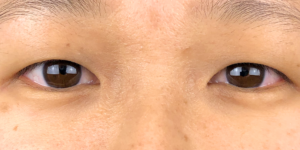 28 [Instant Double Eyelid Surgery]