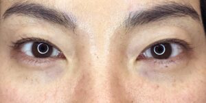 20 [Instant Double Eyelid Surgery]