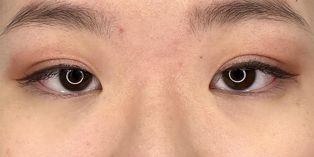 36 [Instant Double Eyelid Surgery]