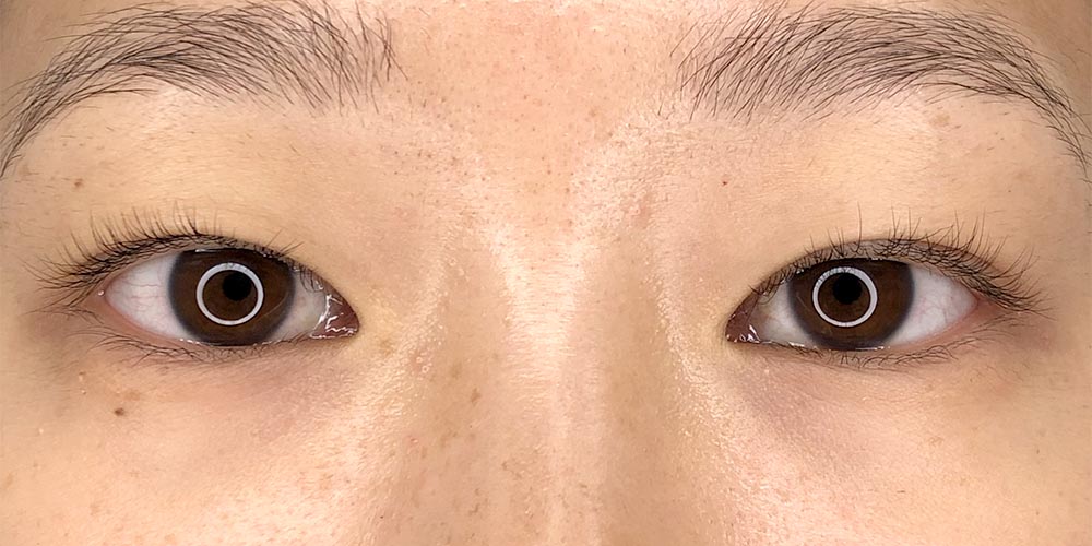 37 [Instant Double Eyelid Surgery]