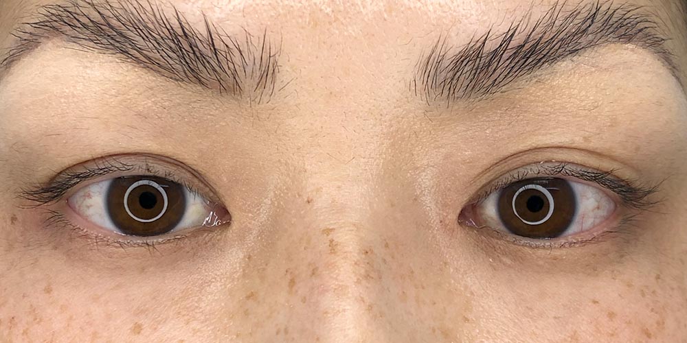 39 [Instant Double Eyelid Surgery]