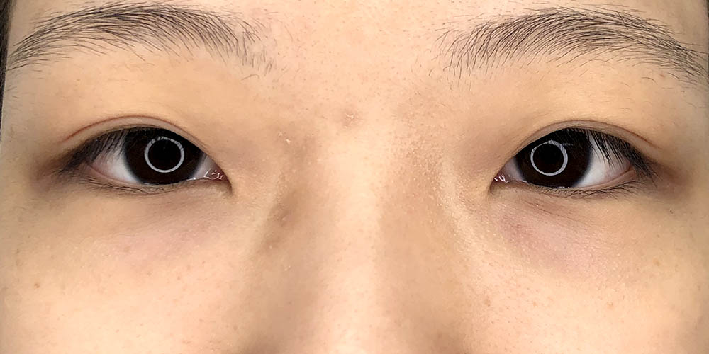 40 [Instant Double Eyelid Surgery]