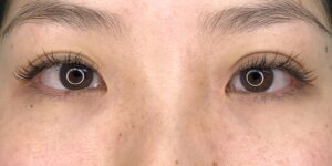 41 [Instant Double Eyelid Surgery]