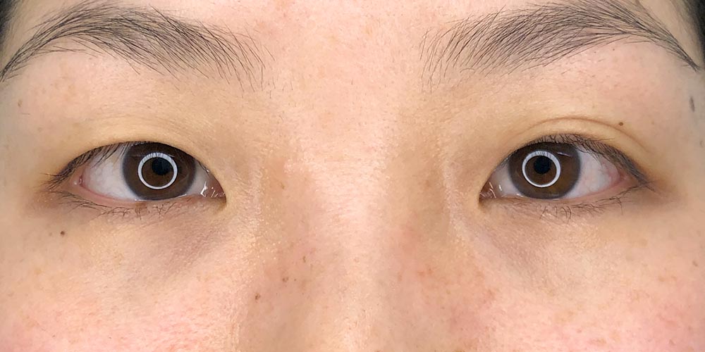 41 [Instant Double Eyelid Surgery]