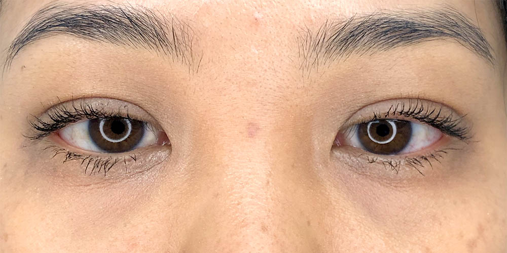 43 [Instant Double Eyelid Surgery]