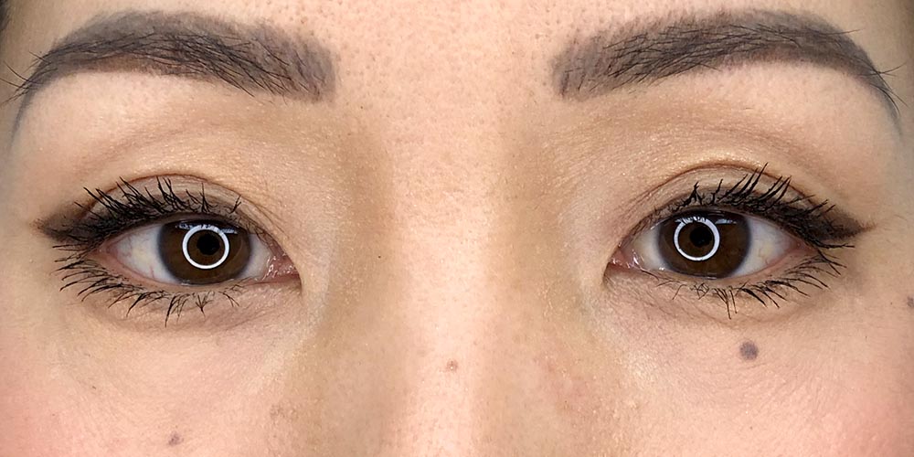 31 [Instant Double Eyelid Surgery]