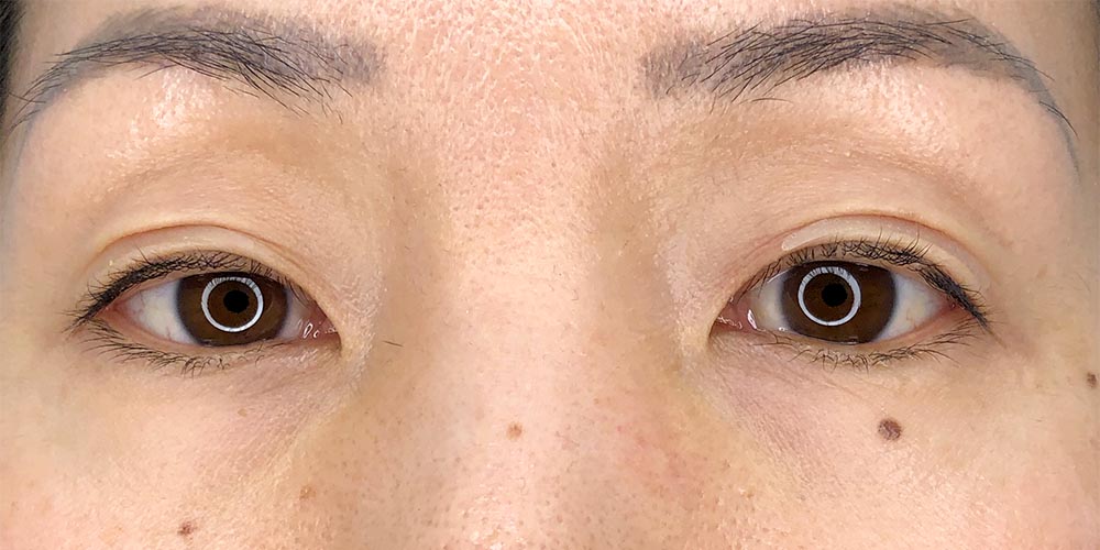 31 [Instant Double Eyelid Surgery]