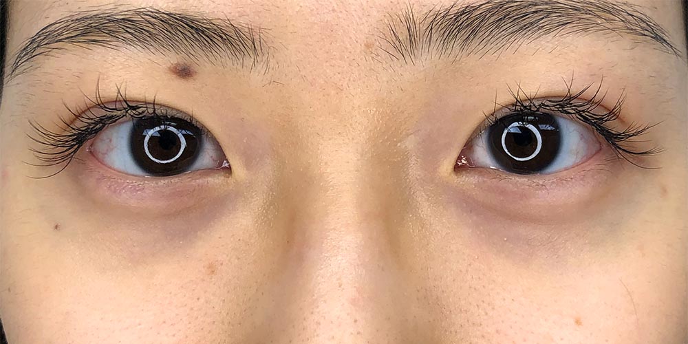 33 [Instant Double Eyelid Surgery]