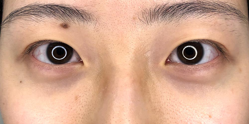 33 [Instant Double Eyelid Surgery]