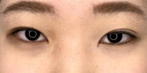 34 [Instant Double Eyelid Surgery]