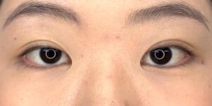 35 [Instant Double Eyelid Surgery]