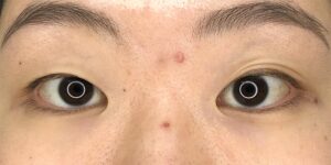 35 [Instant Double Eyelid Surgery]