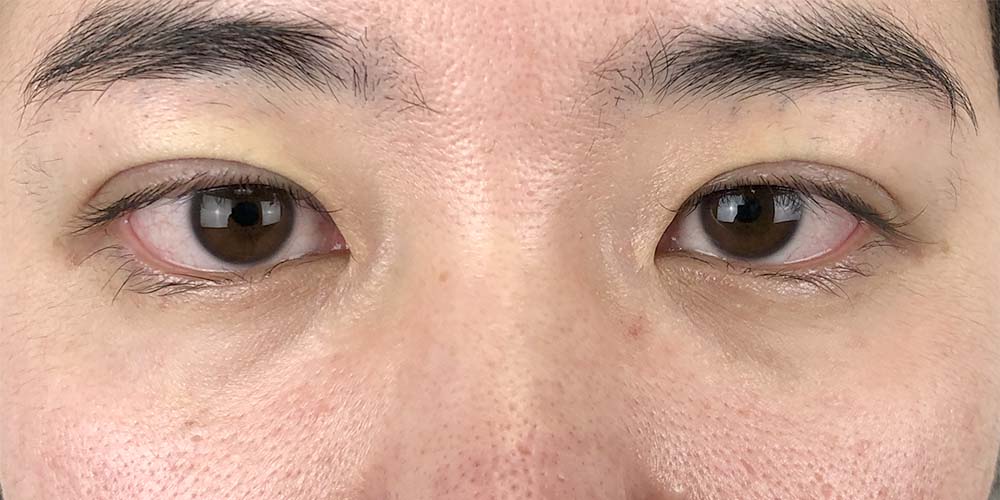 48 [Instant Double Eyelid Surgery]