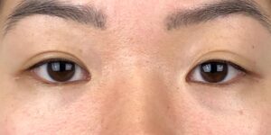 51 [Instant Double Eyelid Surgery]