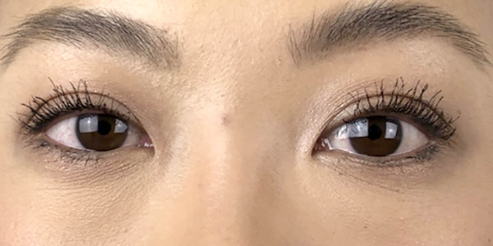 55 [Instant Double Eyelid Surgery]