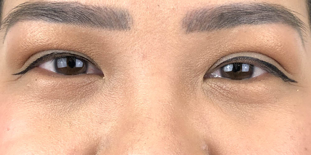 56 [Instant Double Eyelid Surgery]