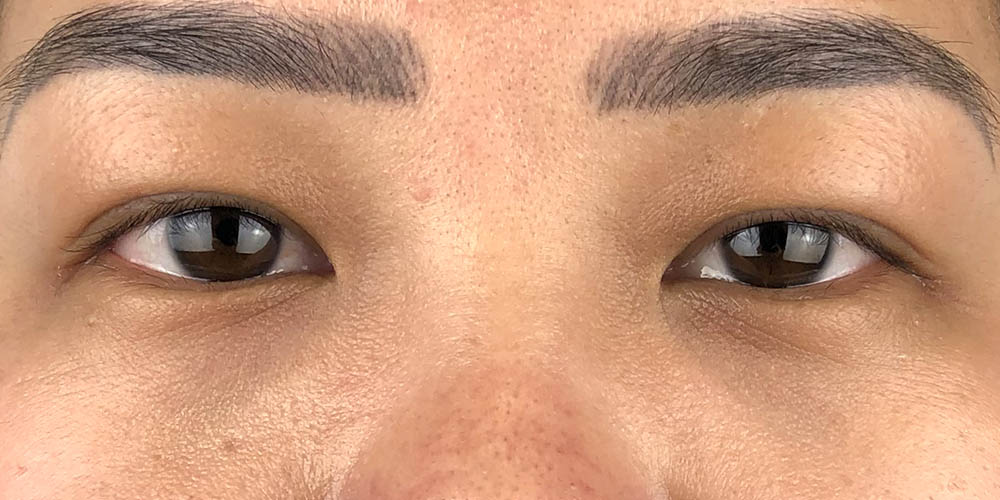 56 [Instant Double Eyelid Surgery]