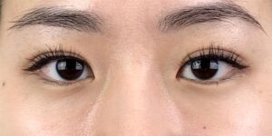 44 [Instant Double Eyelid Surgery]