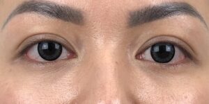 45 [Instant Double Eyelid Surgery]