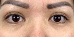 50 [Instant Double Eyelid Surgery]