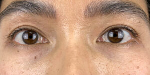 52 [Instant Double Eyelid Surgery]