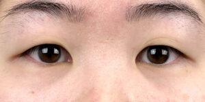 53 [Instant Double Eyelid Surgery]