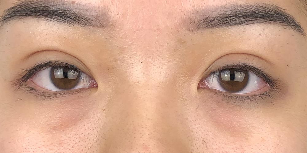 54 [Instant Double Eyelid Surgery]