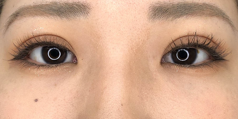 18 [Instant Double Eyelid Surgery]