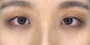30 [Instant Double Eyelid Surgery]