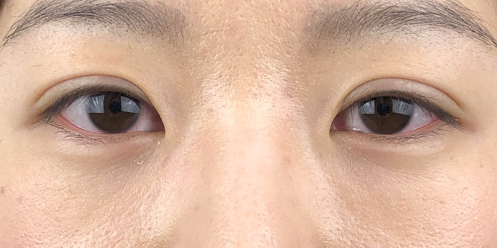 57 [Instant Double Eyelid Surgery]