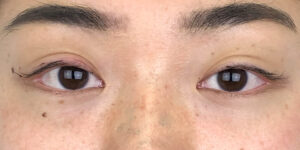 60 [Instant Double Eyelid Surgery]