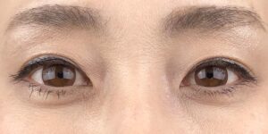 61 [Instant Double Eyelid Surgery]