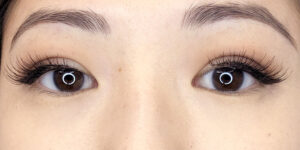 14 [Instant Double Eyelid Surgery]