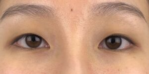 66 [Instant Double Eyelid Surgery]