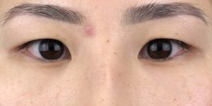 70 [Instant Double Eyelid Surgery]