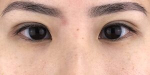 70 [Instant Double Eyelid Surgery]