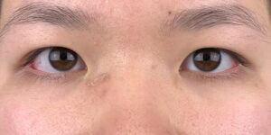 71 [Instant Double Eyelid Surgery]