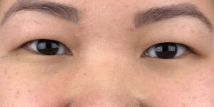 73 [Instant Double Eyelid Surgery]