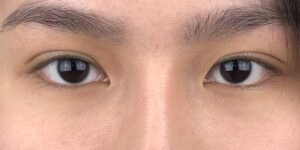 74 [Instant Double Eyelid Surgery]