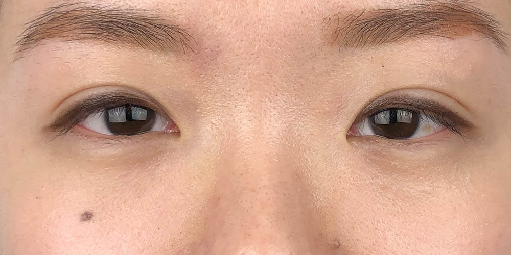 75 [Instant Double Eyelid Surgery]